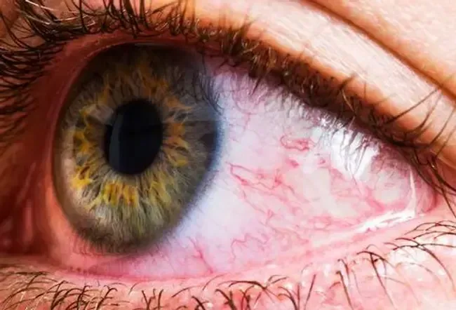 Eye Health: What Your Eye Symptoms May Mean