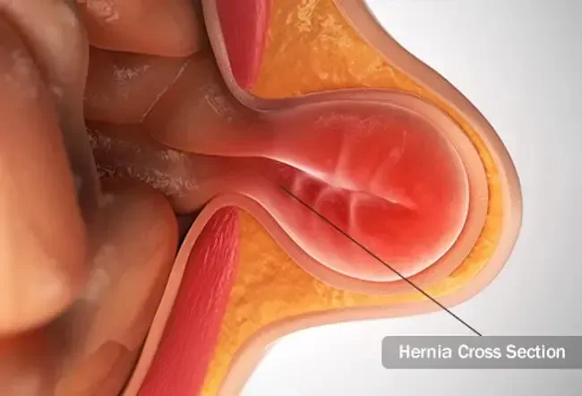Hernias: causes, types et traitements
