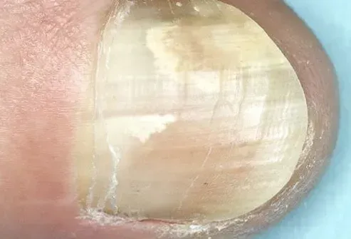 Picture of Onychomycosis (Fungal Nail Infection)