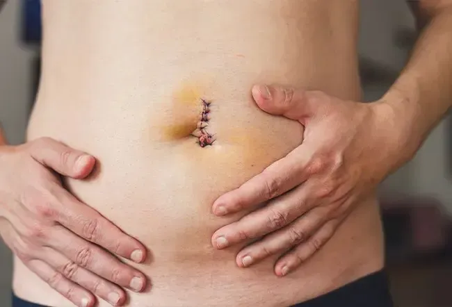 Hernie abdominale