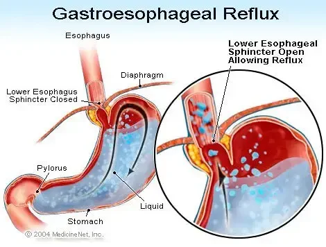 Définition du reflux gastro-œsophagien