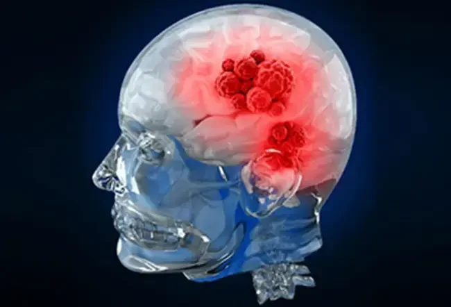 Symptômes, diagnostic et traitement du cancer du cerveau