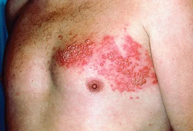 Helvedesild: myter og fakta om helvedesildsvirus