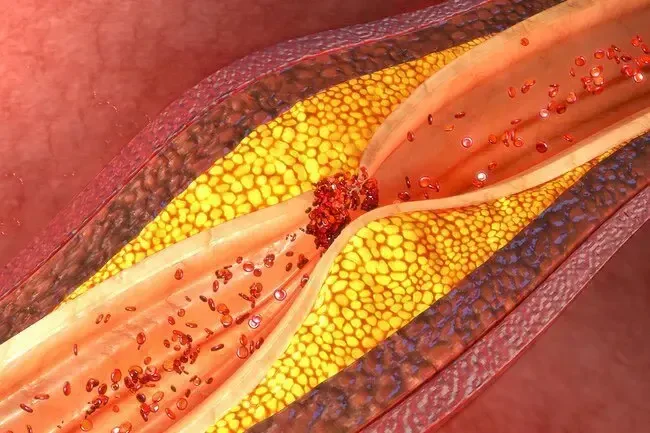 Maladie cardiaque: comprendre vos résultats de test de sang et d'urine