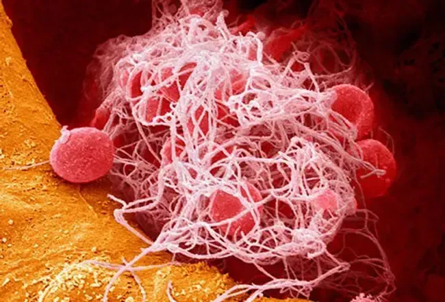 Blood Clots: 4 Signs You Could Have One