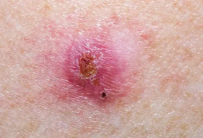 Picture of Basal Cell Carcinoma