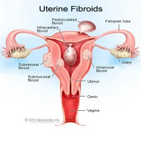 Definition of Uterine fibroids