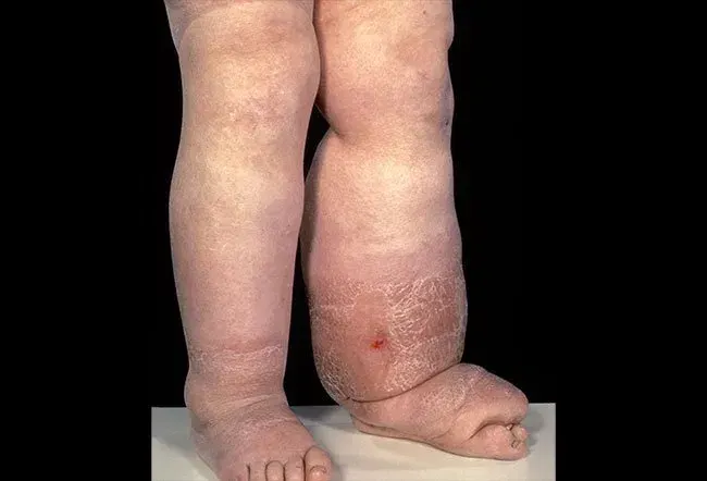 Image du lymphœdème
