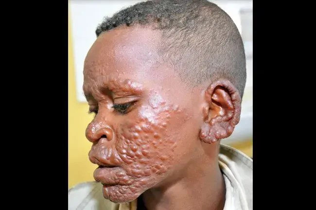 Immagine della lebbra lepromatosa